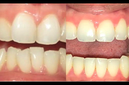 Best Aligners in Abu Dhabi