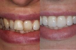 Best Aligners in Dubai
