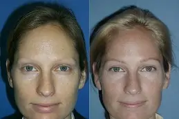Best Blepharoplasty Surgeon Clinic in Dubai