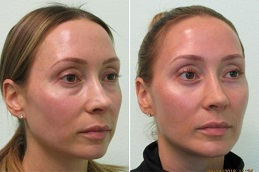 Best Blepharoplasty Surgeon clinic in Dubai & Abu Dhabi