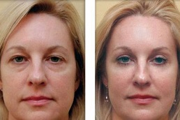 Best Blepharoplasty Surgeon in Dubai & Abu Dhabi