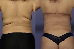 Best Body Lift – Belt Lipectomy Clinic in dubai & Abu Dhabi