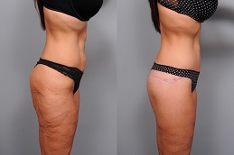 Best Body Lift – Belt Lipectomy Clinic in dubai