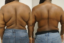 Best Body Lift – Belt Lipectomy in dubai