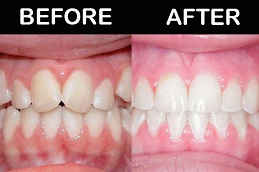 Best Clinic of Aligners in Abu Dhabi