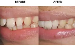 Best Clinic of Aligners in Dubai