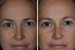 Best Clinic of Blepharoplasty Surgeon in Dubai