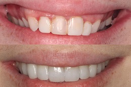 Best Clinic of Hollywood Smile Dubai