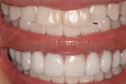 Best Clinic of Hollywood Smile in Dubai
