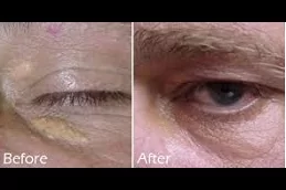 Best Eyelid Xanthelasma Removal Clinic in dubai & Abu Dhabi
