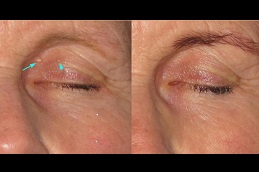 Best Eyelid Xanthelasma Removal Clinic in dubai