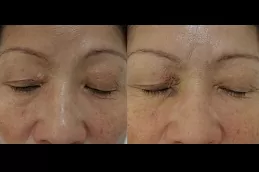 Best Eyelid Xanthelasma Removal in dubai
