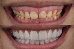 Best Hollywood Smile Dubai