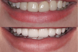 Best Hollywood Smile in Dubai
