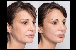 Best Silhouette Soft Thread Lift Clinic in dubai & Abu Dhabi