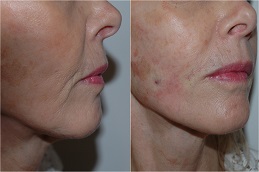 Best Silhouette Soft Thread Lift in dubai