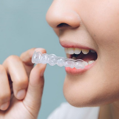 Best Teeth Aligners in Dubai, Abu Dhabi & Sharjah Clear Aligners