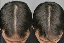 Best baldness-treatment-cost Clinic in Dubai