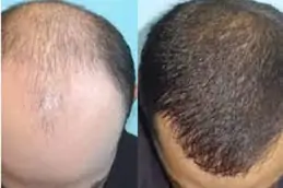 Best baldness-treatment-cost in Abu Dhabi