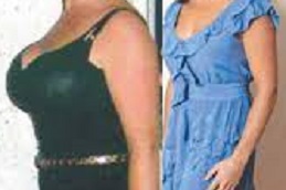 Best breast-reduction-surgery-cost-2022-with-insurance Clinic in Dubai