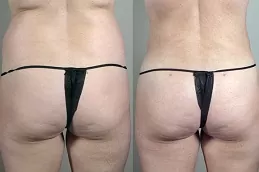 Best butt-fillers in Abu Dhabi