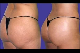 Best butt-fillers in dubai