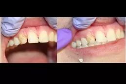 Best-composite-veneers-Abu Dhabi-Cost