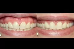 Best-composite-veneers-Clinic-dubai-price