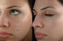 Best do-glutathione-injections-help-with-weight-loss Clinic in Dubai