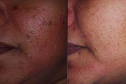 Best do-glutathione-injections-help-with-weight-loss in Abu Dhabi