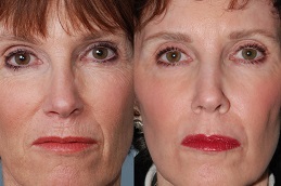 Best erbium-peeling Clinic in Dubai
