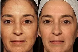 Best erbium-peeling in Abu Dhabi