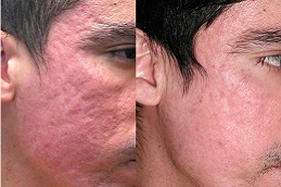 Best erbium-peeling Clinic in Dubai