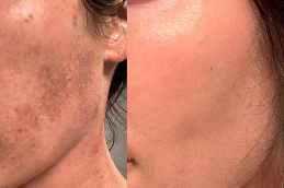 Best evo-laser in dubai