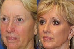 Best face-fat-transfer Clinic in Dubai