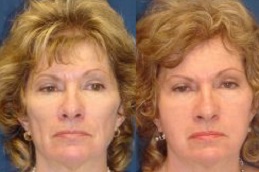 Best face-fat-transfer in Abu Dhabi