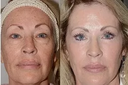Facial treatment Dubai