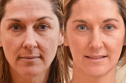 Facial in Dubai