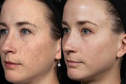 Best facial treatment in dubai