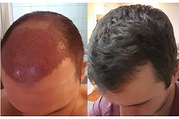 Best hair-transplant-prices Clinic in Dubai