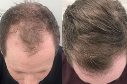 Best hair-transplant-prices in Abu Dhabi