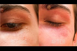 Best milia-treatment Clinic in Dubai