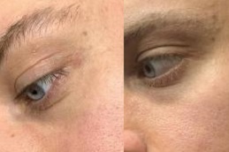 Best milia-treatment in Abu Dhabi