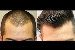 Best natural-hairline-treatment-cost Clinic in Dubai