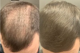 Best natural-hairline-treatment-cost in Abu Dhabi