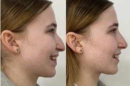Best non-surgical nose lift Clinic in Dubai