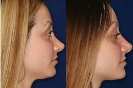 Best non-surgical nose lift in Abu Dhabi