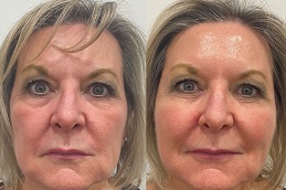 Best pdo-threads-for-jawlines Clinic in Dubai