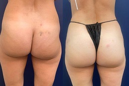 Best sculptra-injections-buttocks-price- abu dhabi