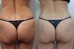 Best sculptra-injections-buttocks-price- clinic dubai